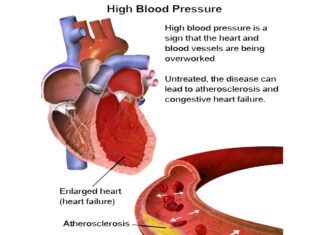 High Blood Pressure