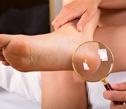 Diseases indicated by cracks in the heels