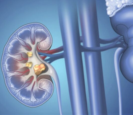 kidney-stones