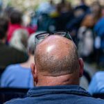 From Luscious Locks to a Shiny Dome: Coping With Premature Baldness Premature Baldness